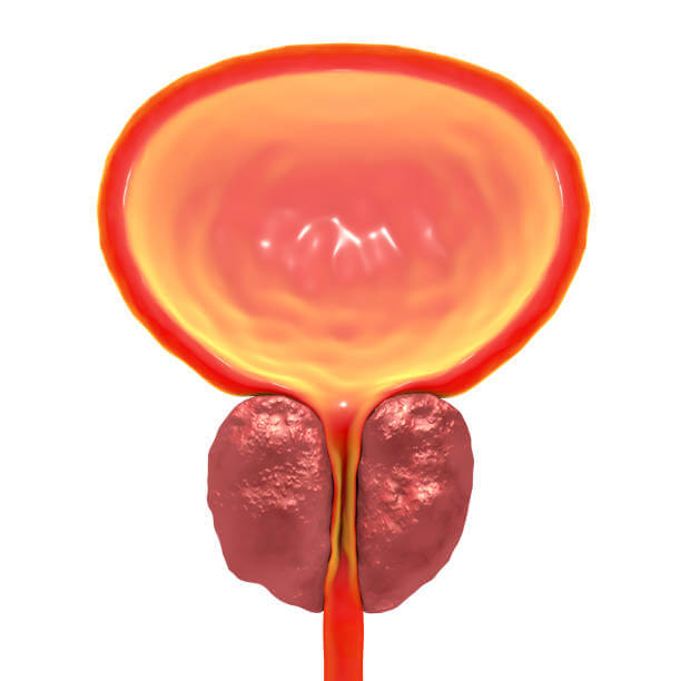 Prostate Enlargement